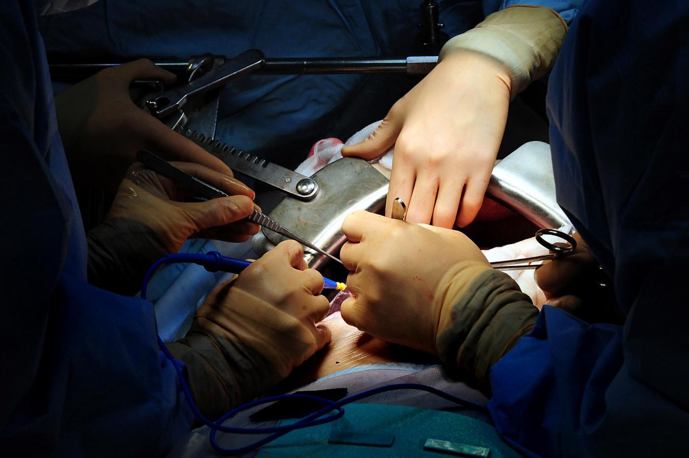 Chirurghi operano con bisturi non adeguati