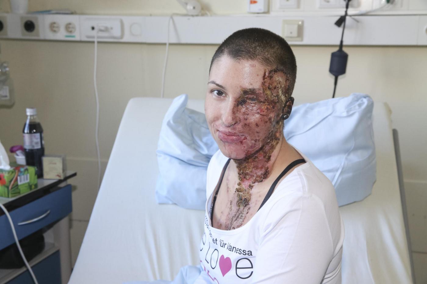 Germania ragazza sfigurata con acido mostra coraggiosamente il suo volto