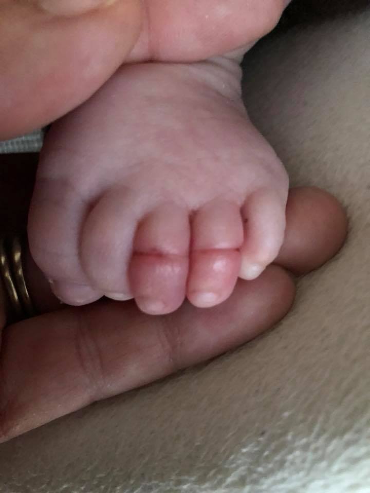dita del bimbo che rischia amputazione per capelli madre