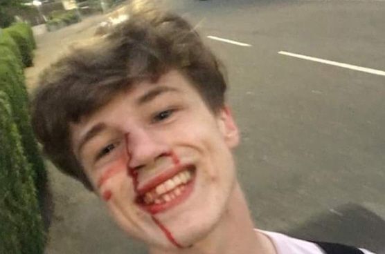 Ragazzo gay picchiato risponde agli omofobi con un sorriso sanguinante la foto diventa virale