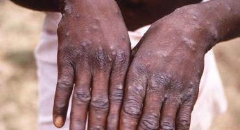 Vaiolo delle scimmie, l’esperto: “Sostanzialmente innocuo, non desta preoccupazioni”