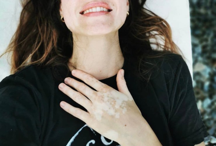 Kasia Smutniac vitiligine (foto Instagram)