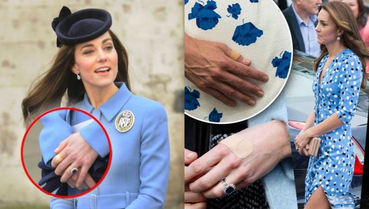Kate Middleton segni sulle mani