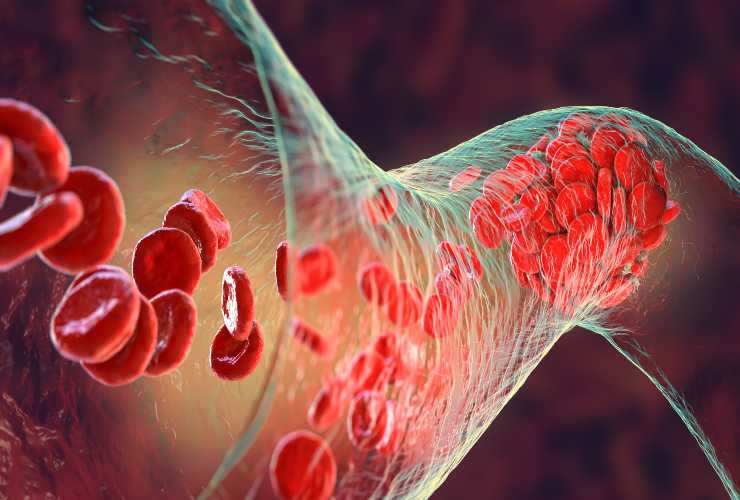 Coagulo di sangue costituito da globuli rossi, piastrine e filamenti proteici di fibrina