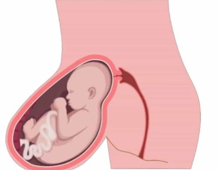 gravidanza ernia